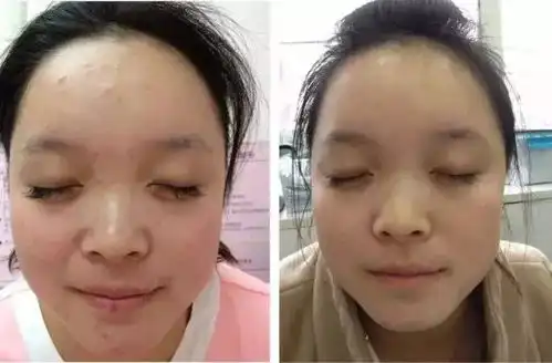 一个痘痘200条虫,长痘痘的脸原来那么脏,你有痘你先看......