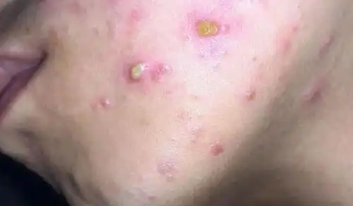 腮帮子长痘痘怎么管理