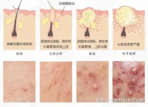 为什么前胸后背痘严重的时候一定要抑制金黄色葡萄球菌