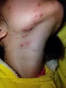 下巴脖子两侧长痘痘有脓包如何是好