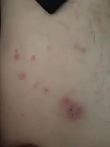前几天腿上长了一片痘痘,有点痒,摸上去又有点疼,有大佬知道这是什么吗