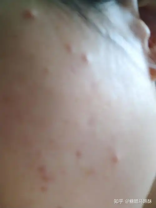 脸上长红色痘痘怎么办