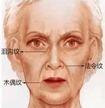 玻尿酸注射能消除法令纹吗