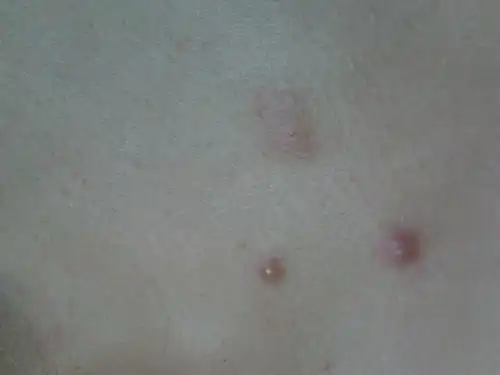 请问长的这个痘痘是什么东西是病毒性软疣还是皮脂腺囊肿不痛偶尔有点痒硬的不会活动长了几年了