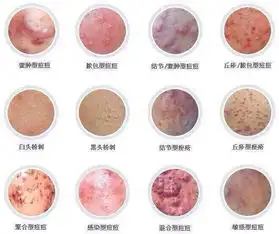 鼻子上长脓包型痘痘怎么办