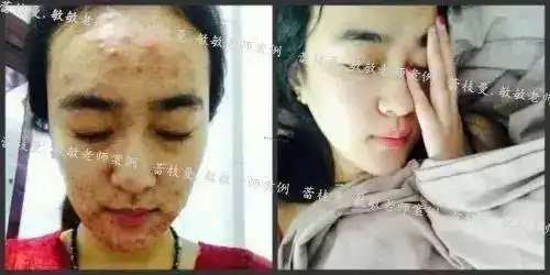 别以为只是痘痘满脸的虫在爬,真相吓死人