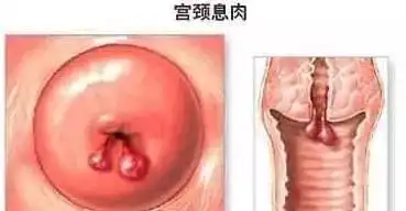 宫颈息肉是什么宫颈息肉到底有多可怕