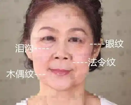 将肉毒素和玻尿酸联合起来使用,除皱效果会更长久哦