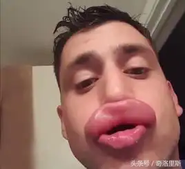 男子为了省下丰唇的钱,拿蜜蜂蛰自己的嘴唇,太造作没网友同情