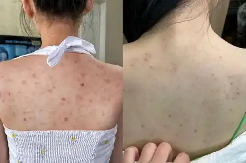 女生后背痘痘怎么靠刷酸去除的3步背部刷酸方法,1个月轻松消灭后背痘痘