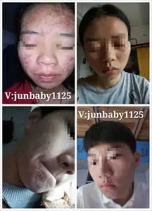 极尚名膜有哪些祛痘产品祛痘多久有效会不会爆痘