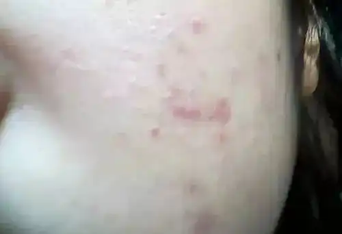 这里长肉粒可不是痘痘那么简单快看看你脖子上有吗