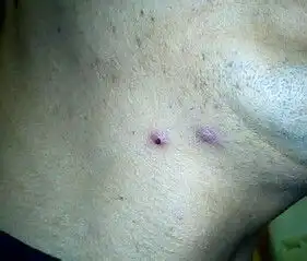 脖子上长红痘痘红疙瘩怎么回事如何解决