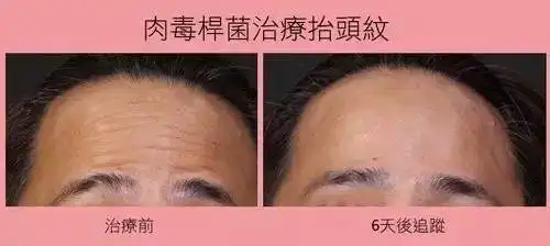 肉毒素除皱的意外效果失去了表情,心也变得麻木了